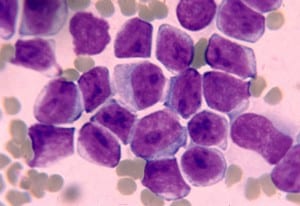Questi "cosi grossi viola" sono globuli bianchi (linfociti) aggregati a formare un piccolo tumore.