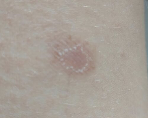 micosi del gatto sull'uomo